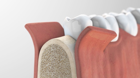 Das Bild zeigt eine Zahnreihe mit einem fehlenden Zahn, der durch ein Implantat ersetzt wird und dient als Beitragsbild