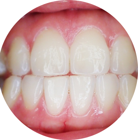 Das Bild zeigt Zähne und Zahnfleisch und dient als Titelbild für das Thema "Parodontitis mit der Parodontitisbehandlung aufhalten".