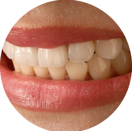 Das Bild zeigt die schönen, geraden und weißen Frontzähne einer Frau und dient als Titelbild für das Thema „Zahnverblendung mit Keramikveneers“.