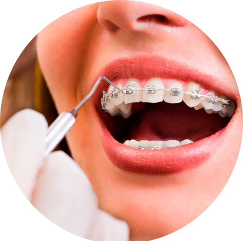 Das Bild zeigt die Kontrolle von Brackets einer Zahnspange und dient als Beitragsbild für das Thema "Kieferorthopädische Behandlung für Patienten aus Lingen, Meppen, Nordhorn und Umgebung".