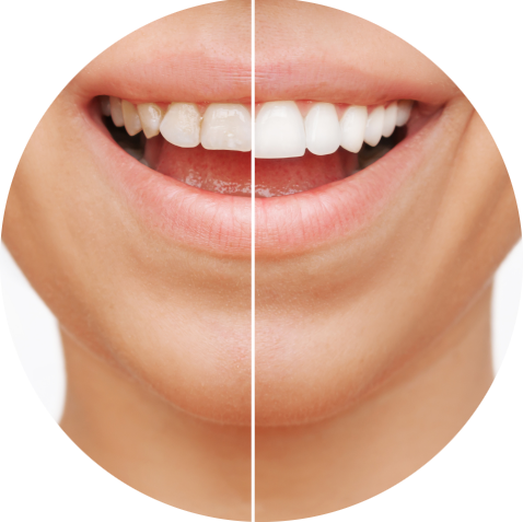 Das Bild zeigt die Frontzähne einer Frau vor und nach einer ästethischen Zahnbehandlung und dient als Titelbild für das Thema "Zahnästhetik".
